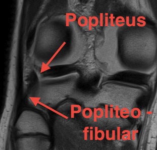 Popliteofibular MRI